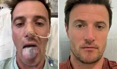 Homem quase perde a língua por causa do HPV: 'Não sabia que poderia causar câncer em homens'