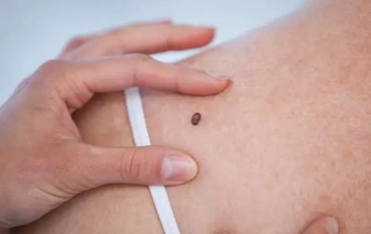 Vacina contra câncer de pele tem resultados positivos e vai entrar em fase final de estudo